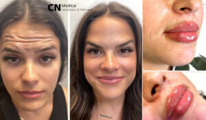 Botox and lip filler treatment at CN Medical Aesthetics & Wellness.