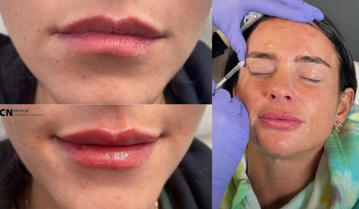 Before and after photos of botox treatment and lip fillers.