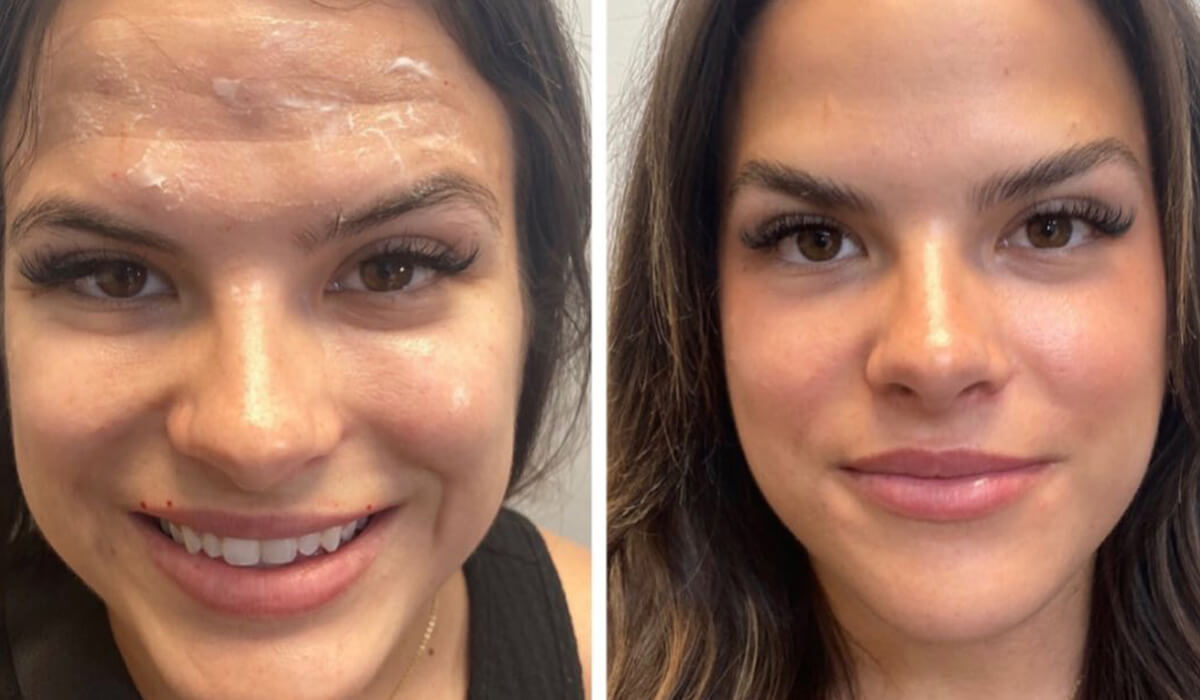 Before and after photo of botox treatment.