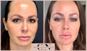 a photo of a woman before and after botox treatment