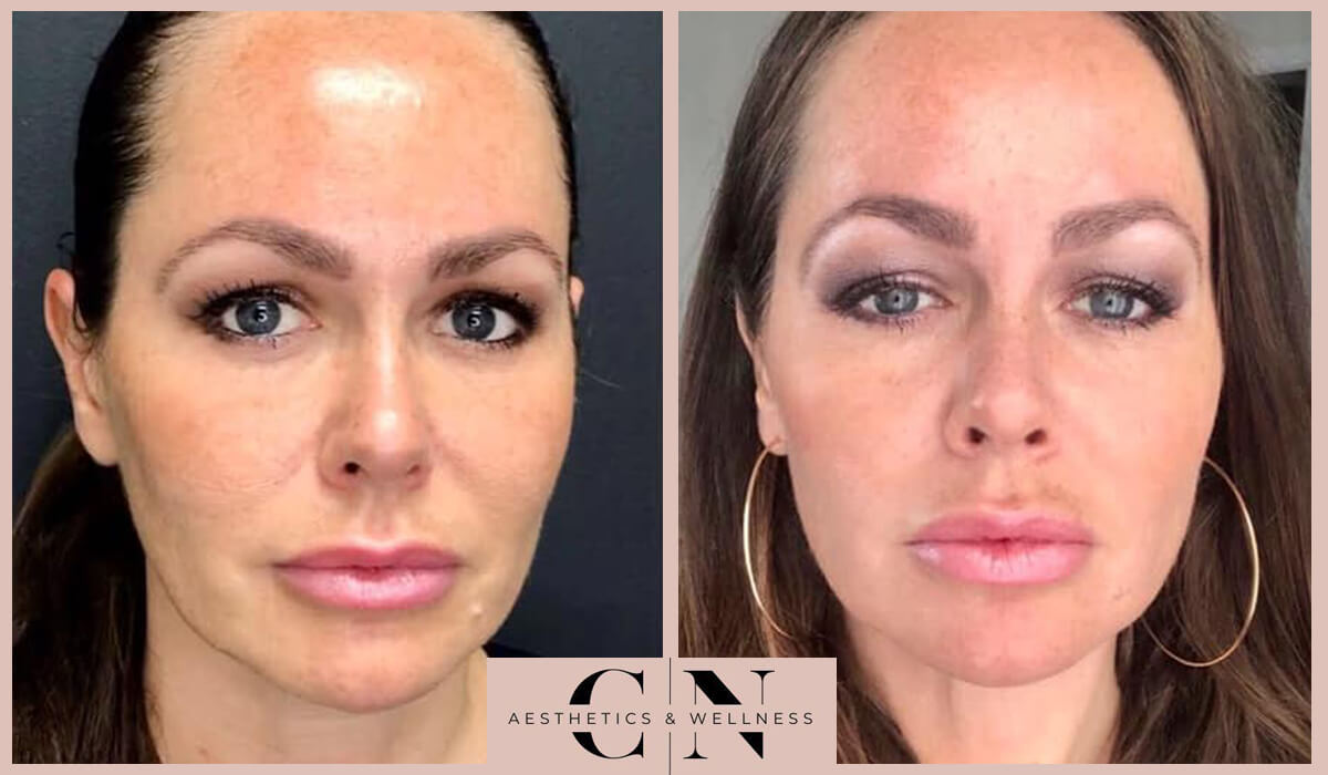 a photo of a woman before and after botox treatment