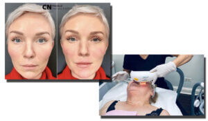 Botox before and after. Botox for frown lines.