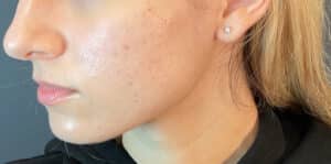 After Image: Microneedling
