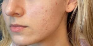 Before Image: Microneedling