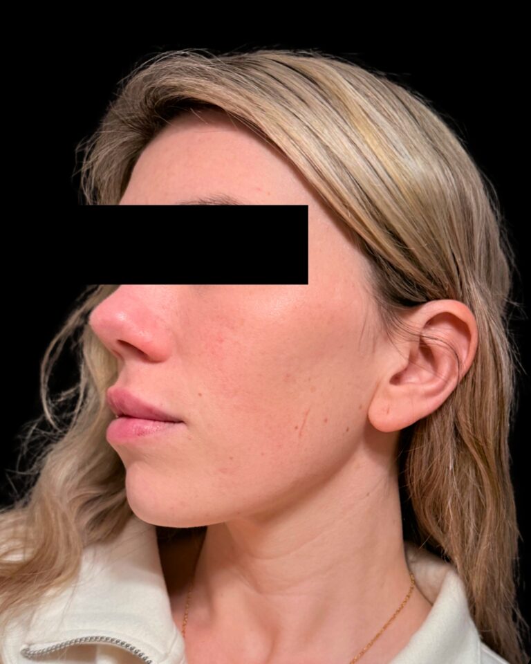 After Image: Combined Treatments - left-side