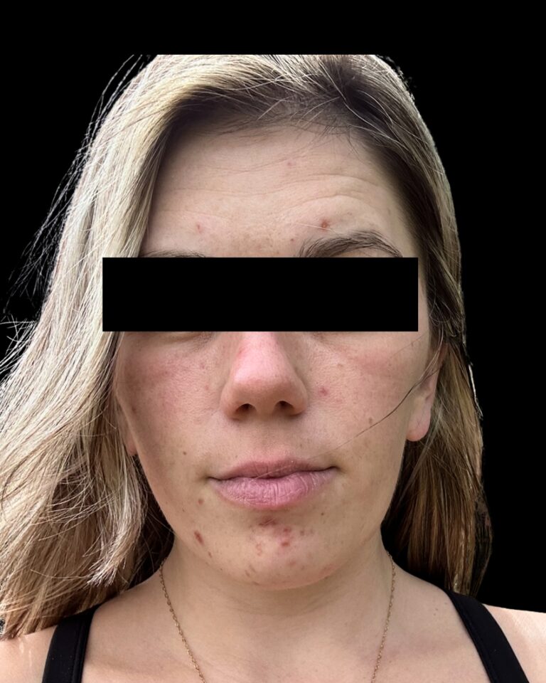 Before Image: Combined Treatments - front