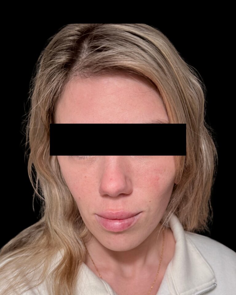 After Image: Combined Treatments - front