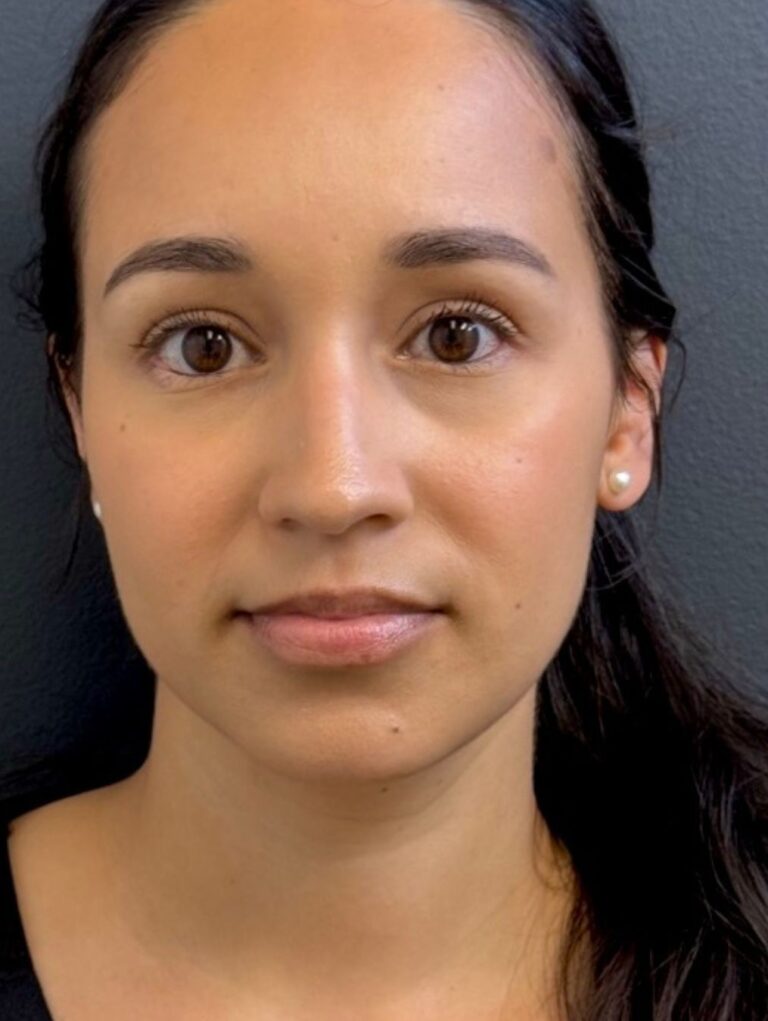 Before Image: Evolysse Smooth- Lip Filler - front