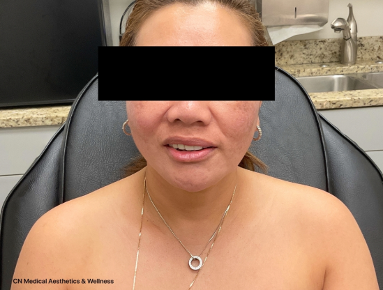 Before Image: Jeuveau - front