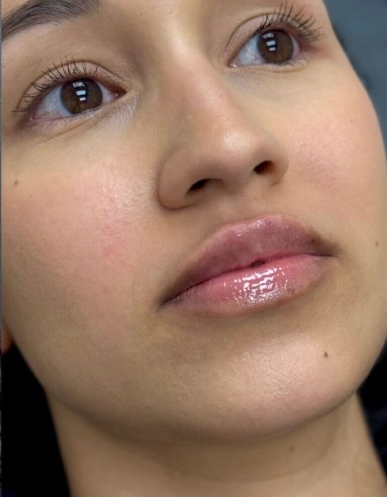 After Image: Evolysse Smooth- Lip Filler - front