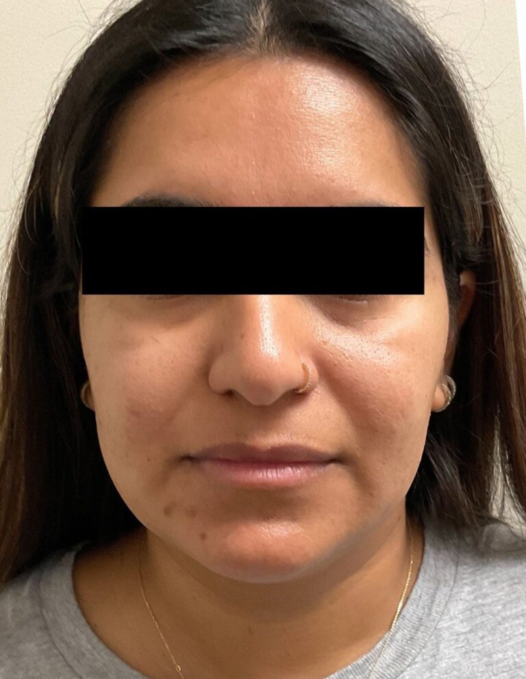 Before Image: Microneedling - front