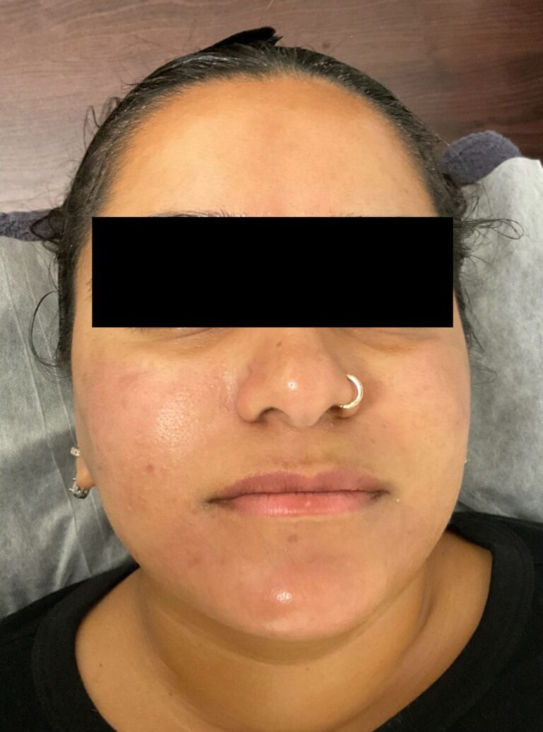 After Image: Microneedling - front