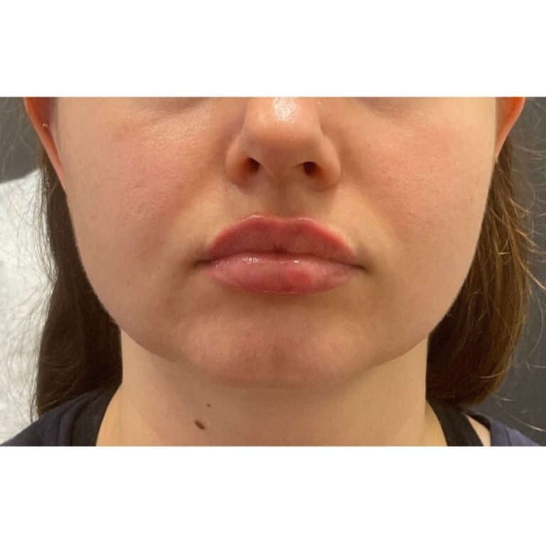After Image: Lip Filler- Versa - front