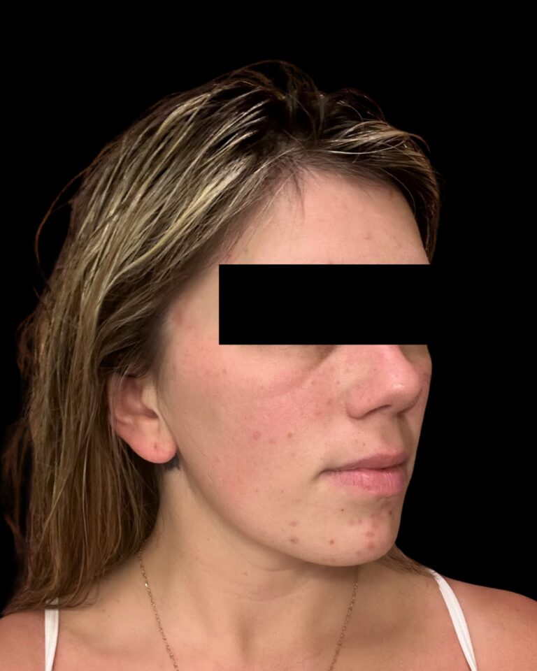 Before Image: Combined Treatments - right-side