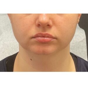Before Image: Lip Filler- Versa