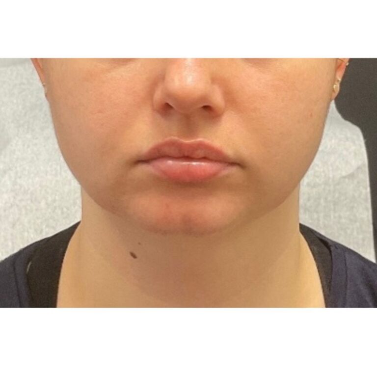 Before Image: Lip Filler- Versa - front