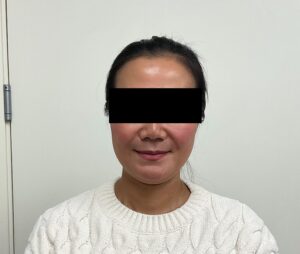 Before Image: Sculptra & Lip Filler