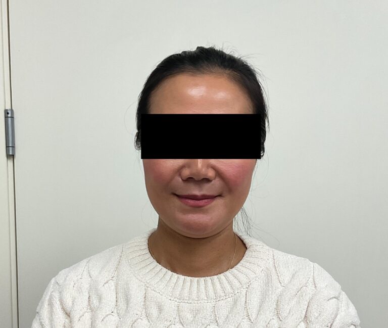 Before Image: Sculptra & Lip Filler - front