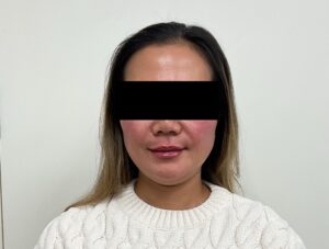 After Image: Sculptra & Lip Filler