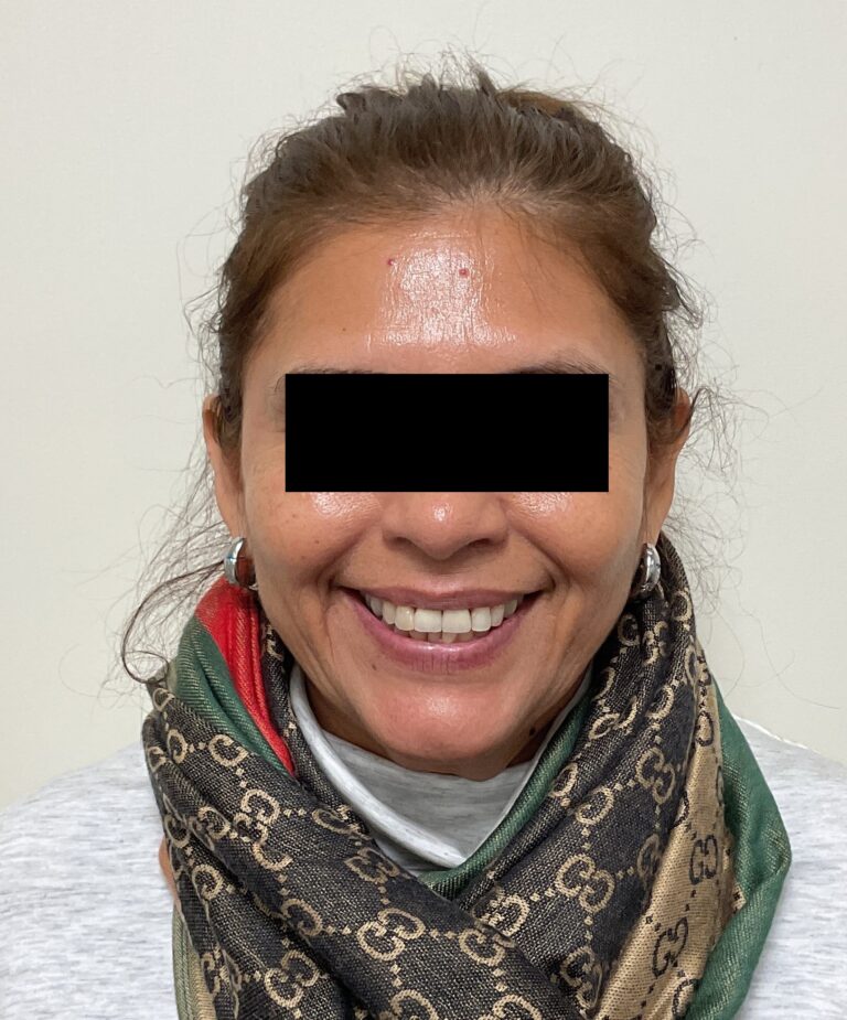 After Image: Dysport - 