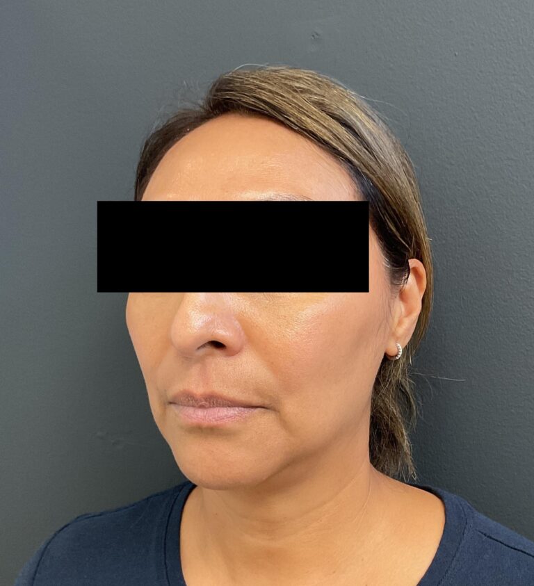 Before Image: Lip Filler - front