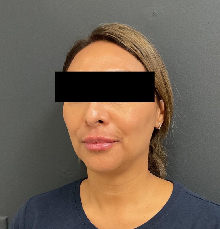 After Image: Lip Filler - front