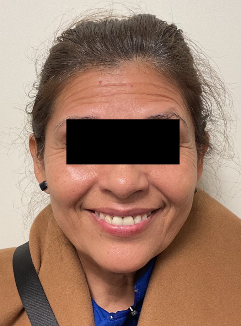 Before Image: Dysport - 