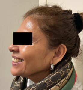 After Image: Dysport