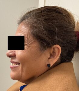 Before Image: Dysport