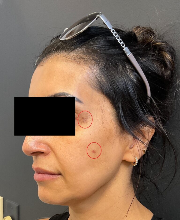 Before Image: IPL - front