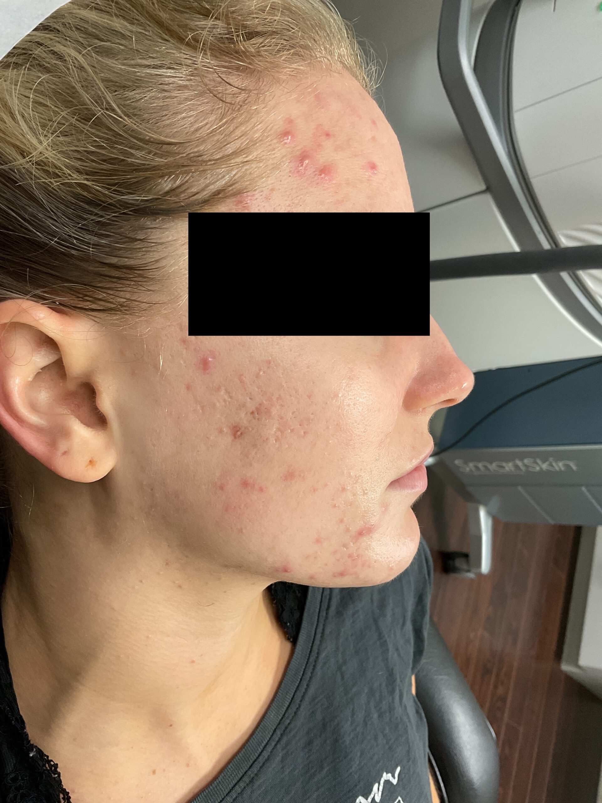 Before Image: IPL for Acne - right-side
