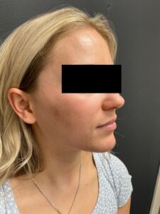 After Image: IPL for Acne