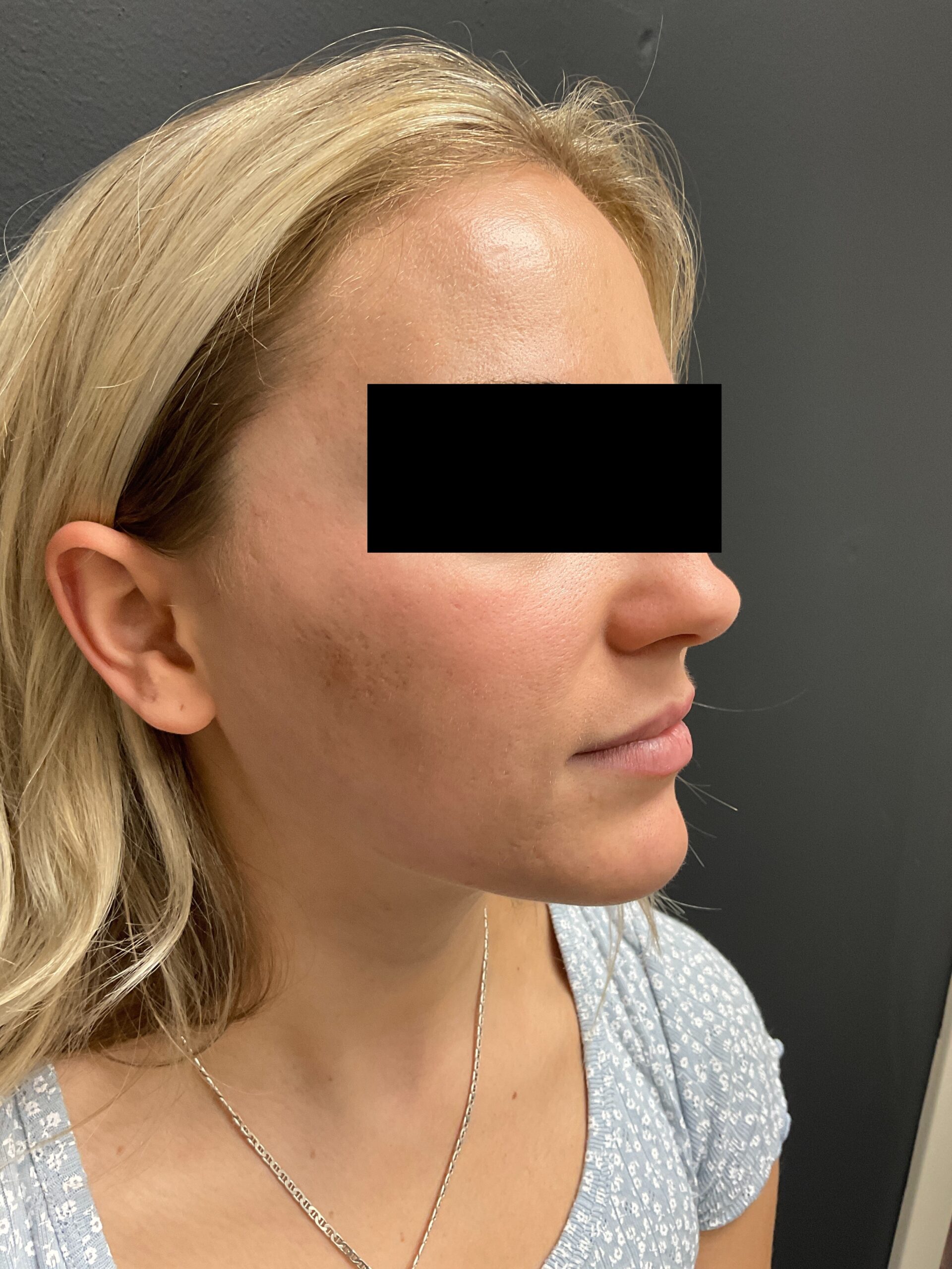 After Image: IPL for Acne - right-side