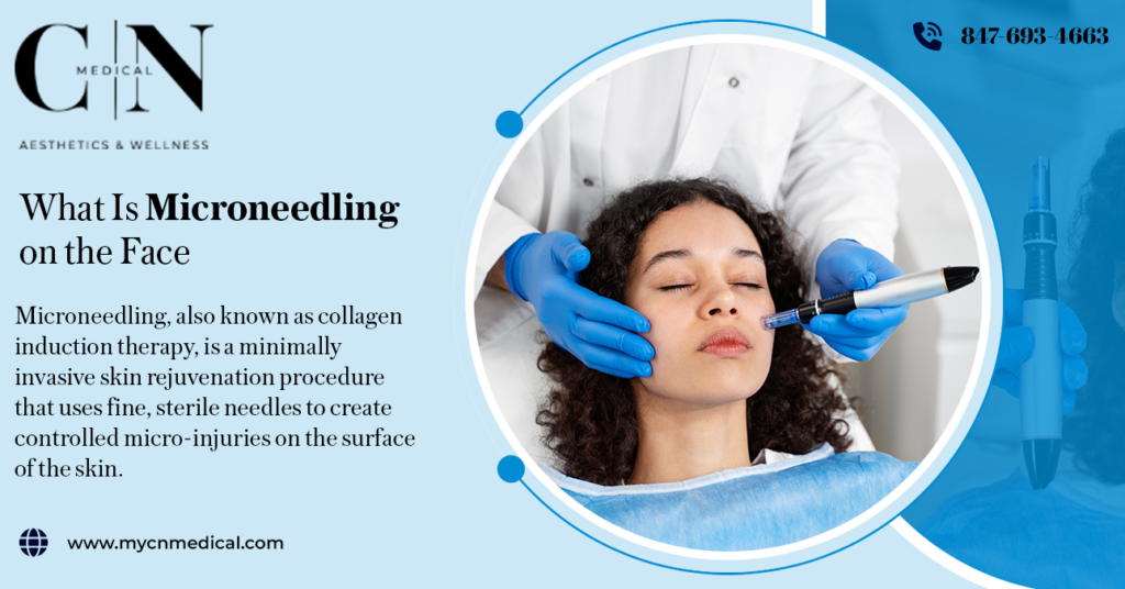 what is microneedling on face