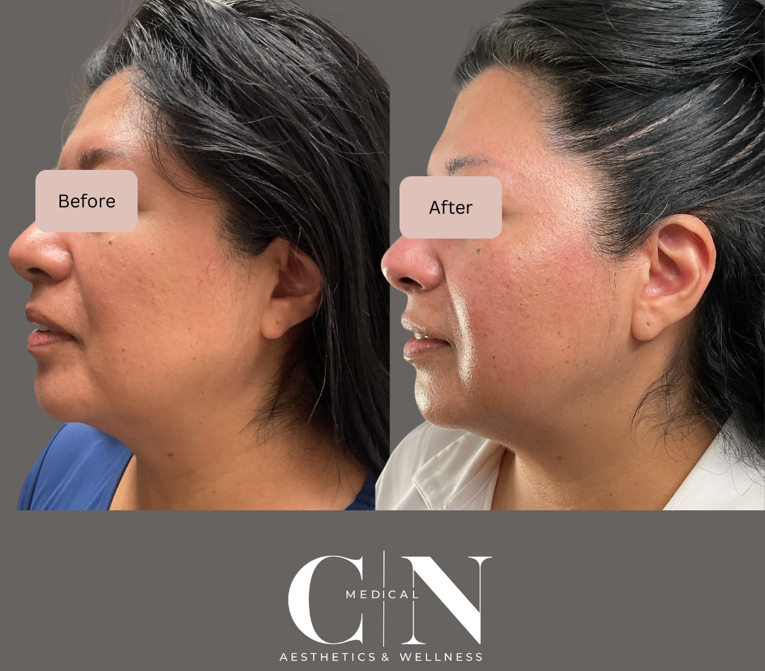 Before and After Image: Microneedling - left-side