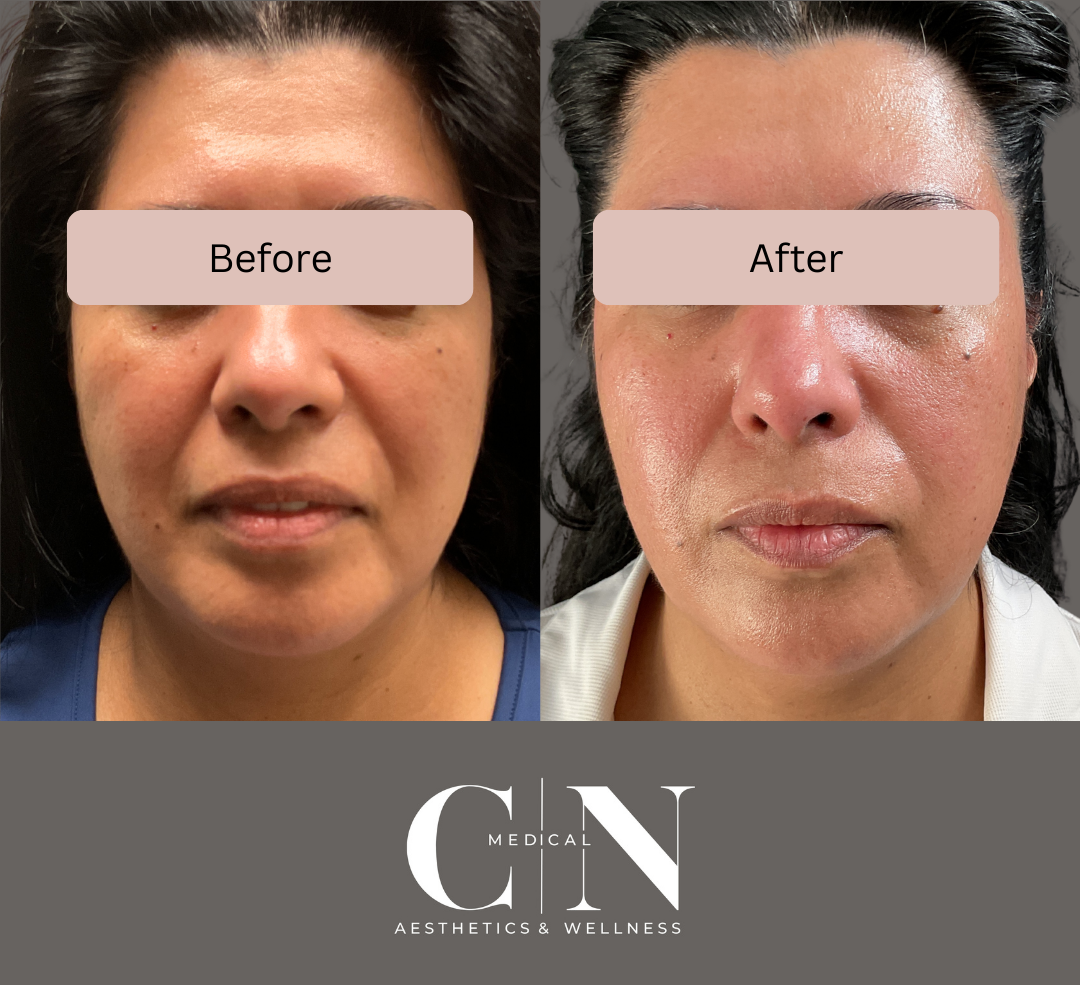 Before and After Image: Microneedling - front