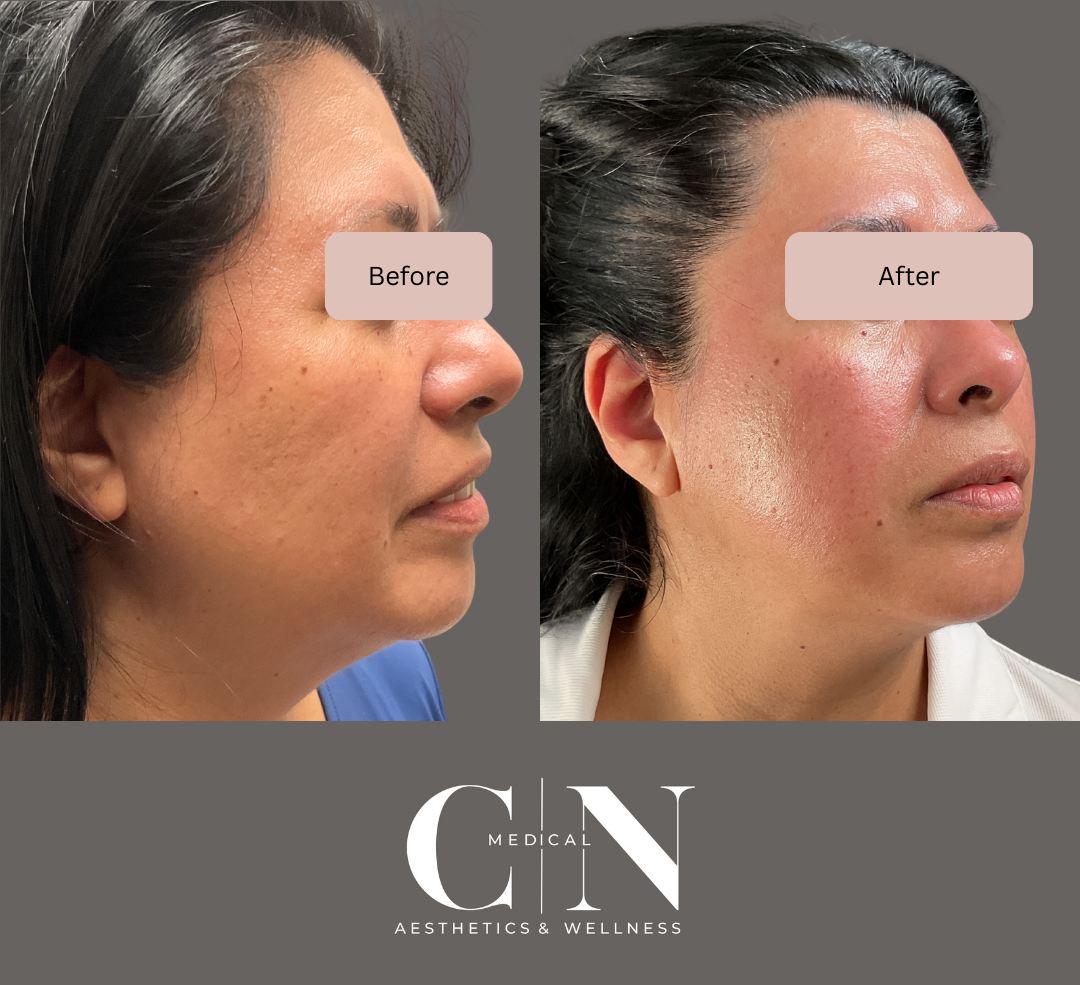 Before and After Image: Microneedling - right-side