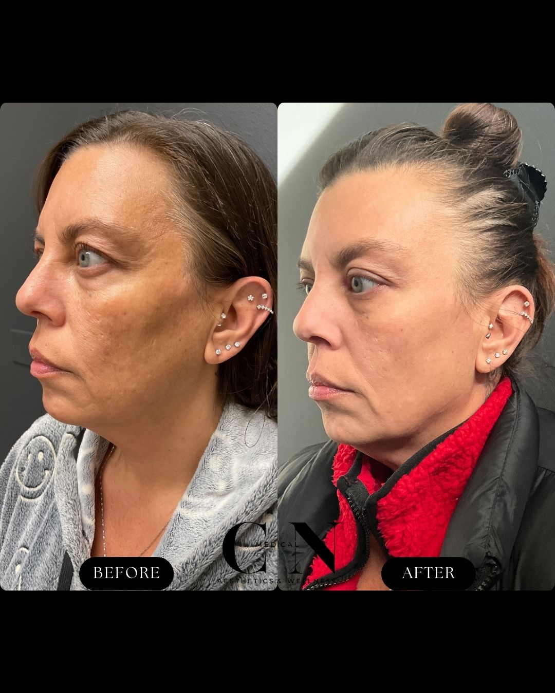 Before and After Image: Microlaser - front