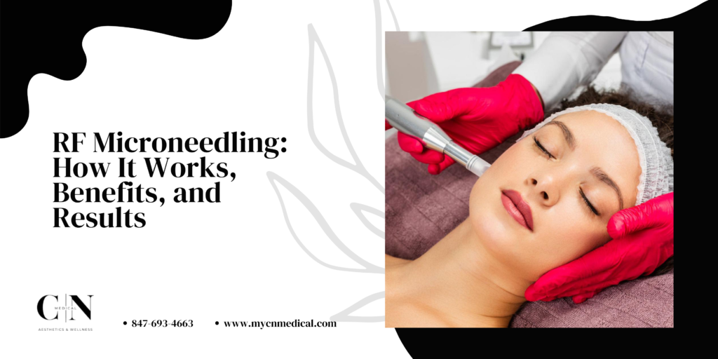 RF Microneedling How It Works, Benefits, Results