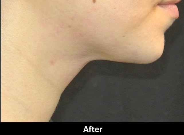 After Image: Kybella-Double Chin Eraser - front