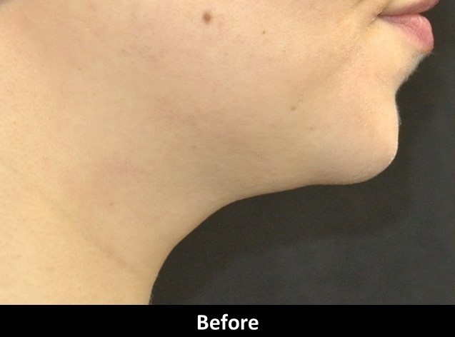 Before Image: Kybella-Double Chin Eraser - front