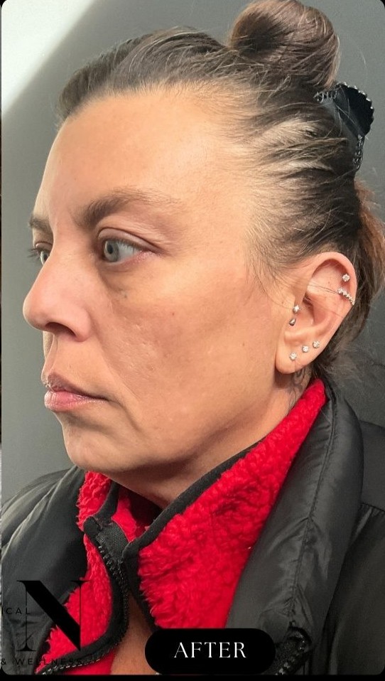 After Image: CO2 Microlaser Resurfacing - left-front-oblique