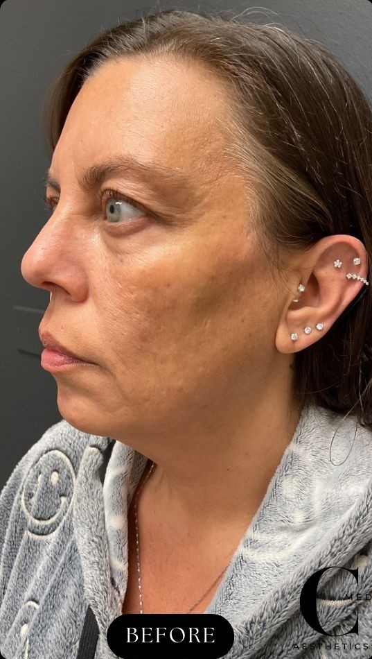 Before Image: CO2 Microlaser Resurfacing - left-front-oblique