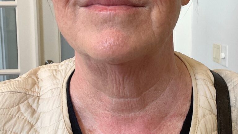 After Image: Turkey Neck Rescue- Microneedling - front