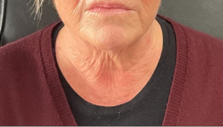 Before Image: Turkey Neck Rescue- Microneedling - front