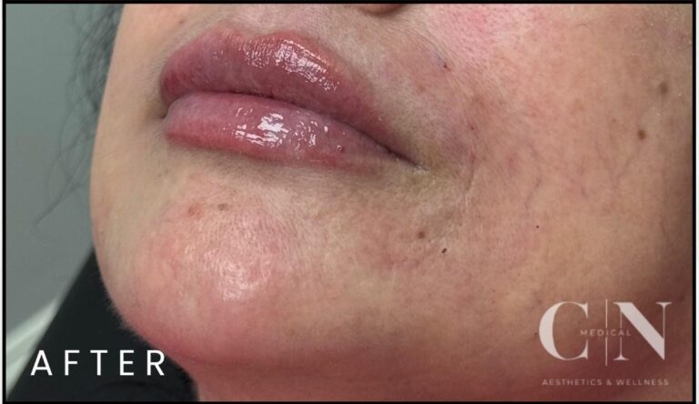 After Image: Lip & Smile Line Filler - front