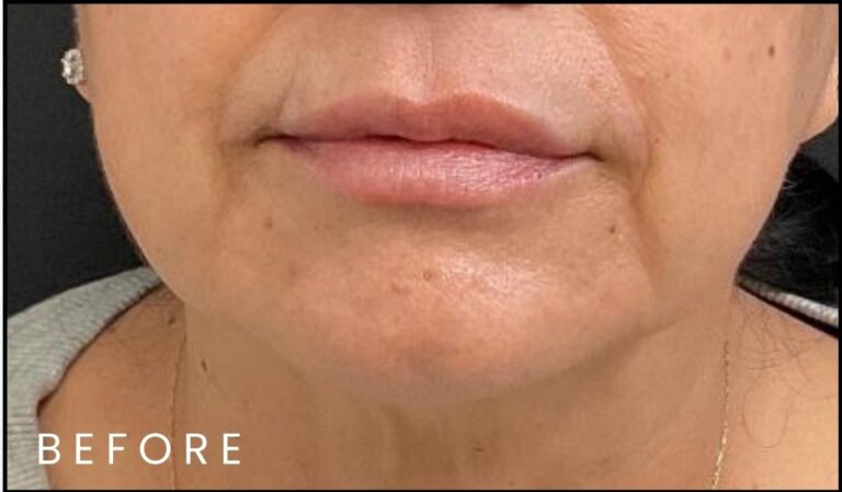 Before Image: Lip & Smile Line Filler - front