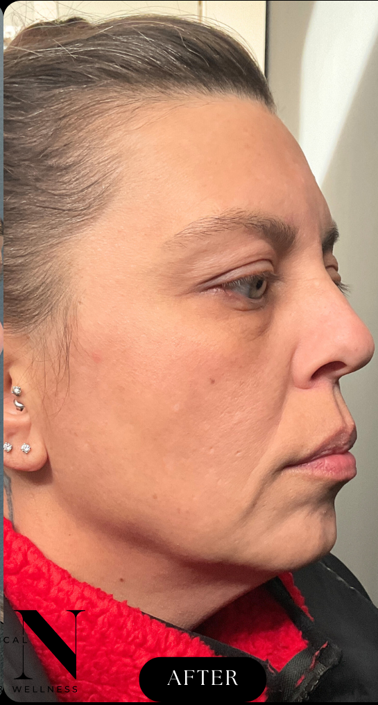 After Image: CO2 Microlaser Resurfacing - right-front-oblique