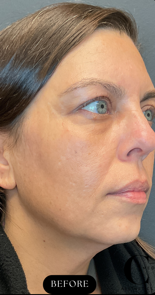 Before Image: CO2 Microlaser Resurfacing - right-front-oblique